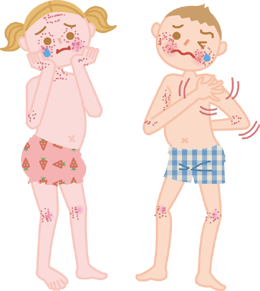 アトピー性皮膚炎