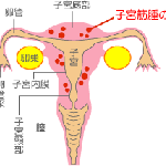子宮筋腫